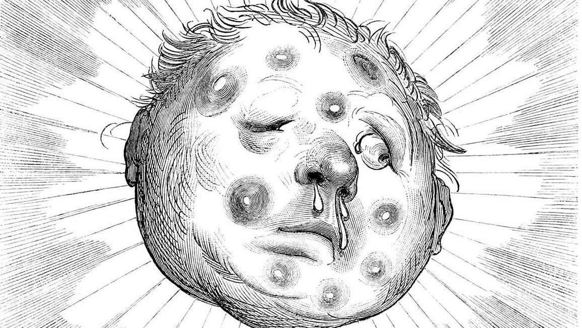A black and white image of a cartoon moon face with large, unsightly boils